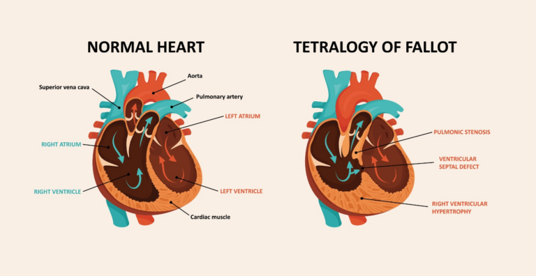 Tetralogy Of Fallot