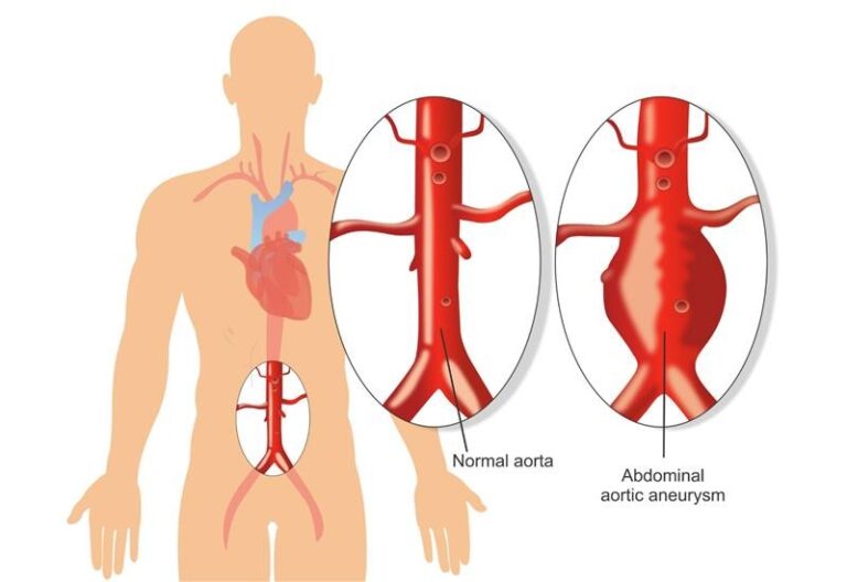Aortic Aneurysm