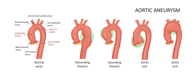 Aortic Aneurysm
