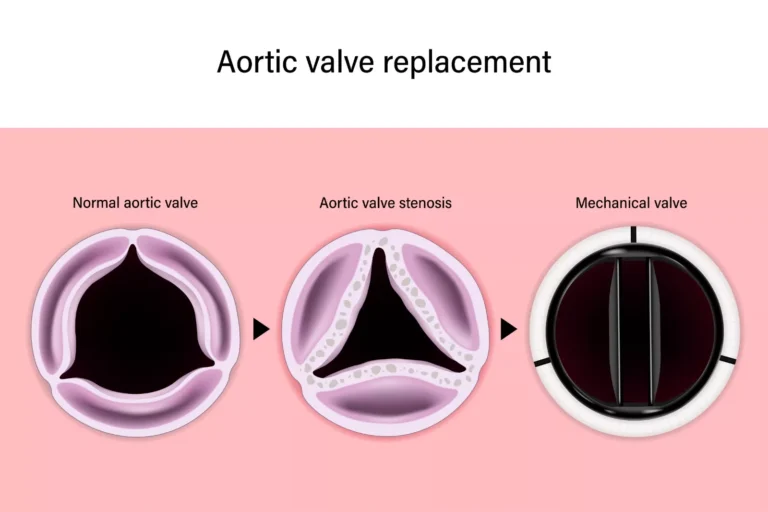 Aortic Valve Replacement