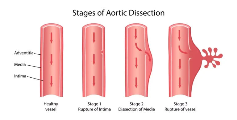 Stages