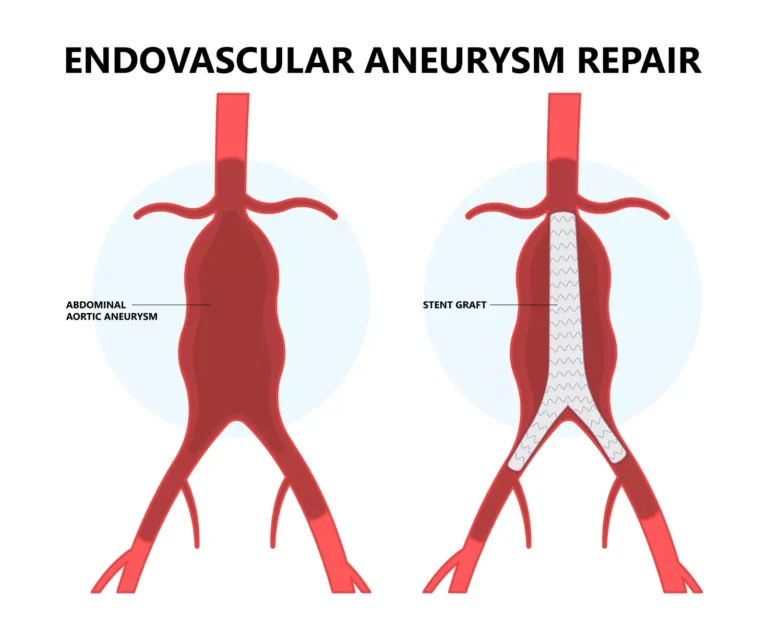 endovascular-aneurysm-repair