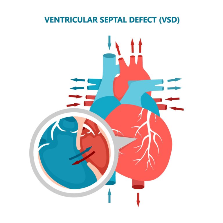 Ventricular Septal Defects (VSD)