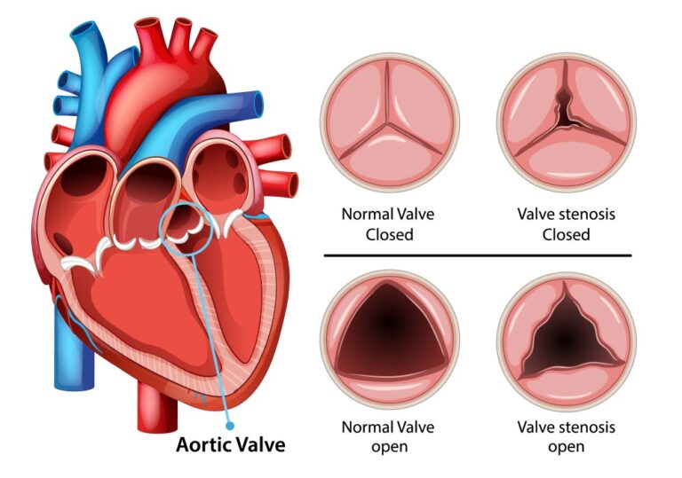 Ventricular Septal Defects (VSD)