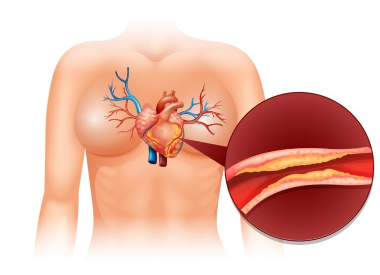 Aortic Dissection
