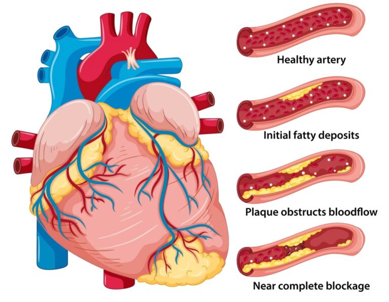 Carotid Artery Disease